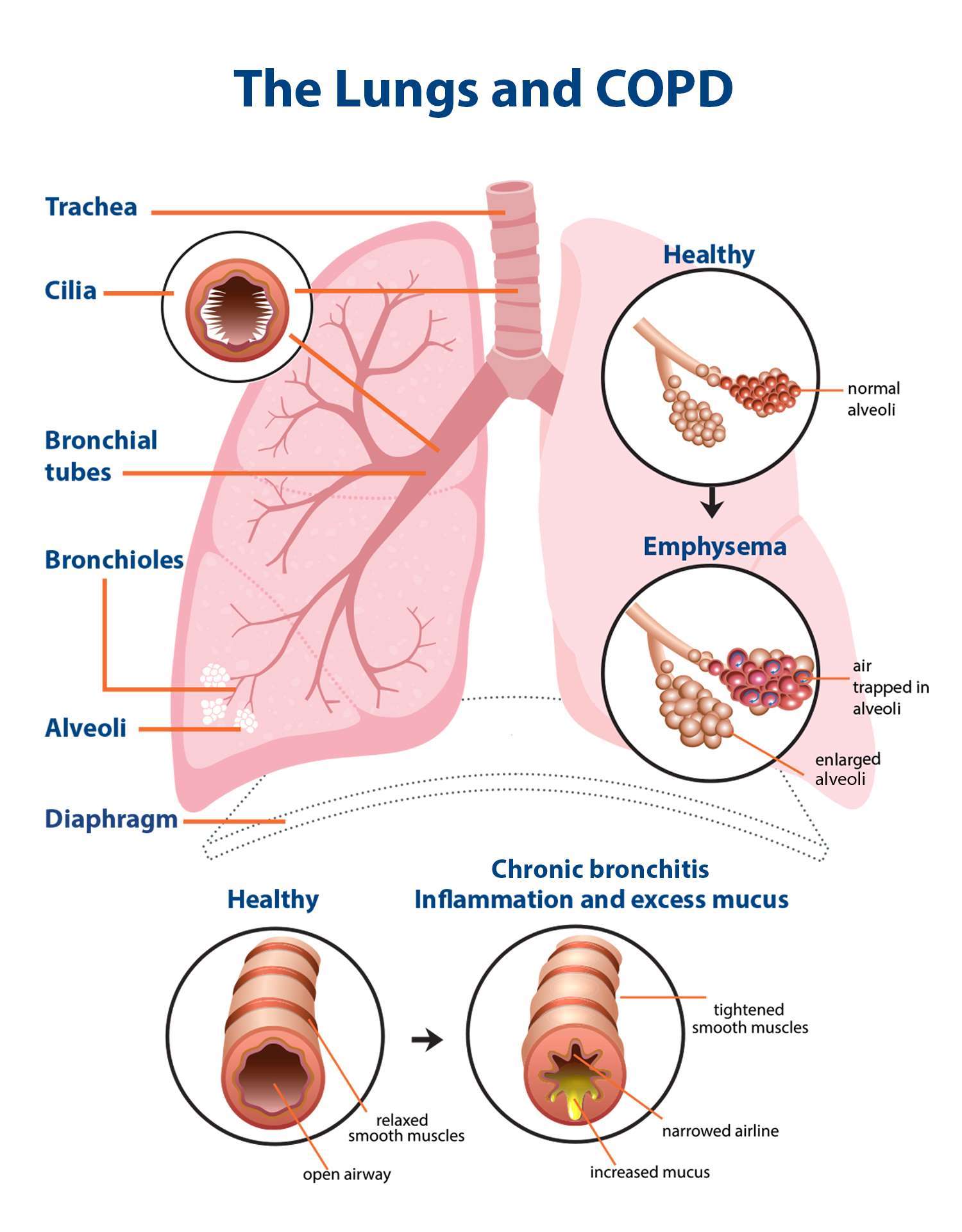 Understanding Copd Check in - Why is it important to know what happens to your lungs with ...