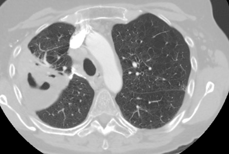 Emphysema Related Death