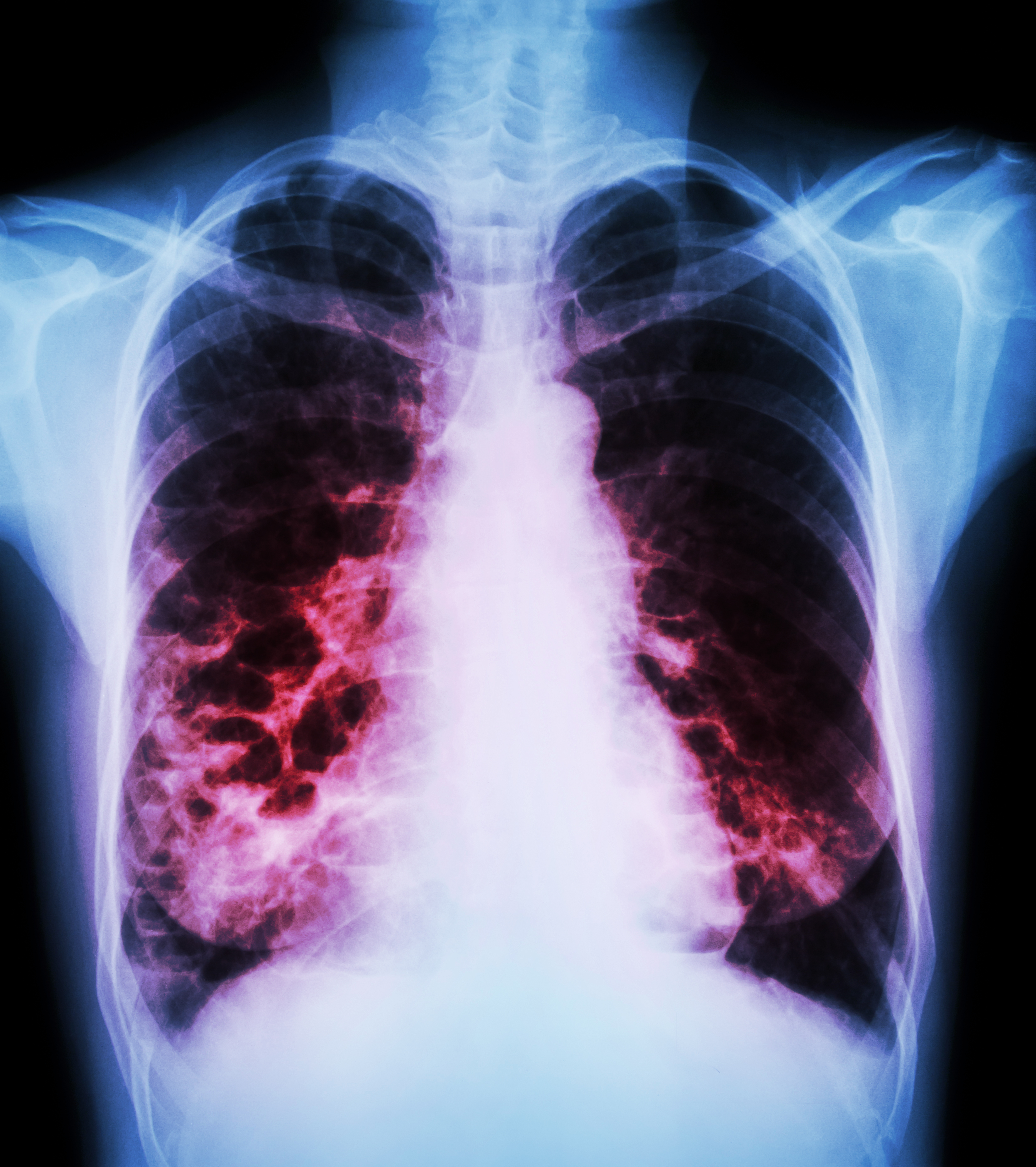How To Cure Pulmonary Fibrosis Naturally How To Cure Pulmonary Fibrosis Naturally