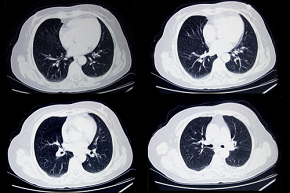CT scans detect COPD